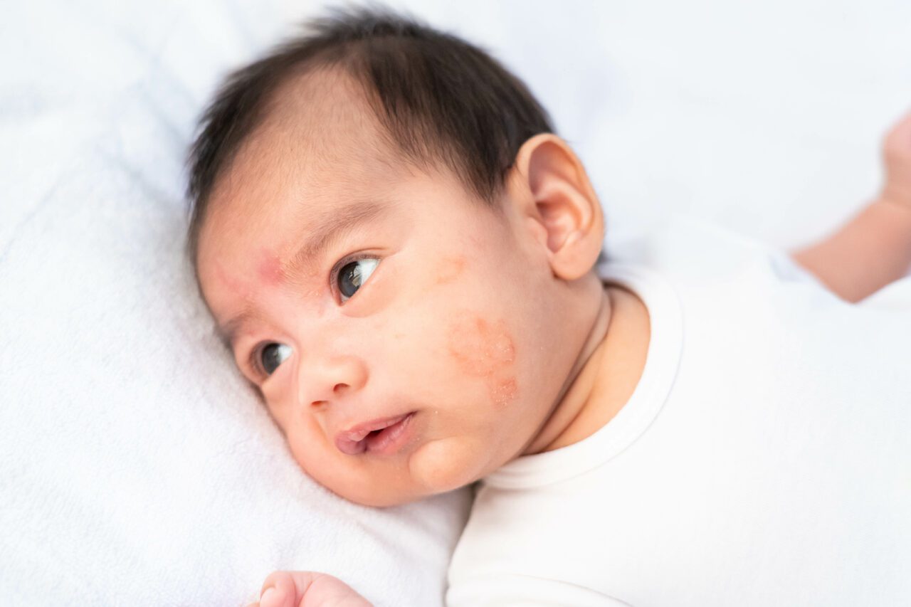 Close up face of newborn baby with eczema on the cheek, concept