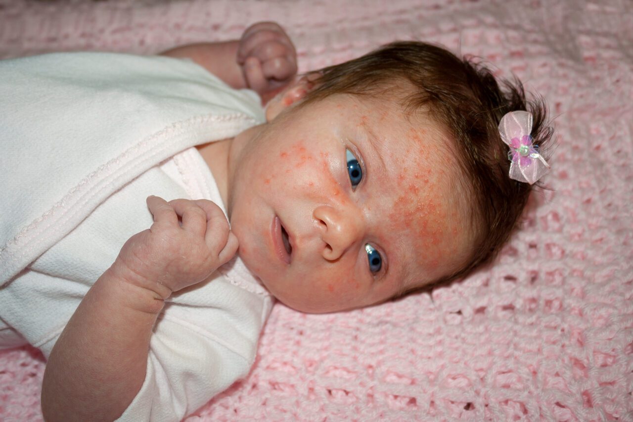 baby-acne