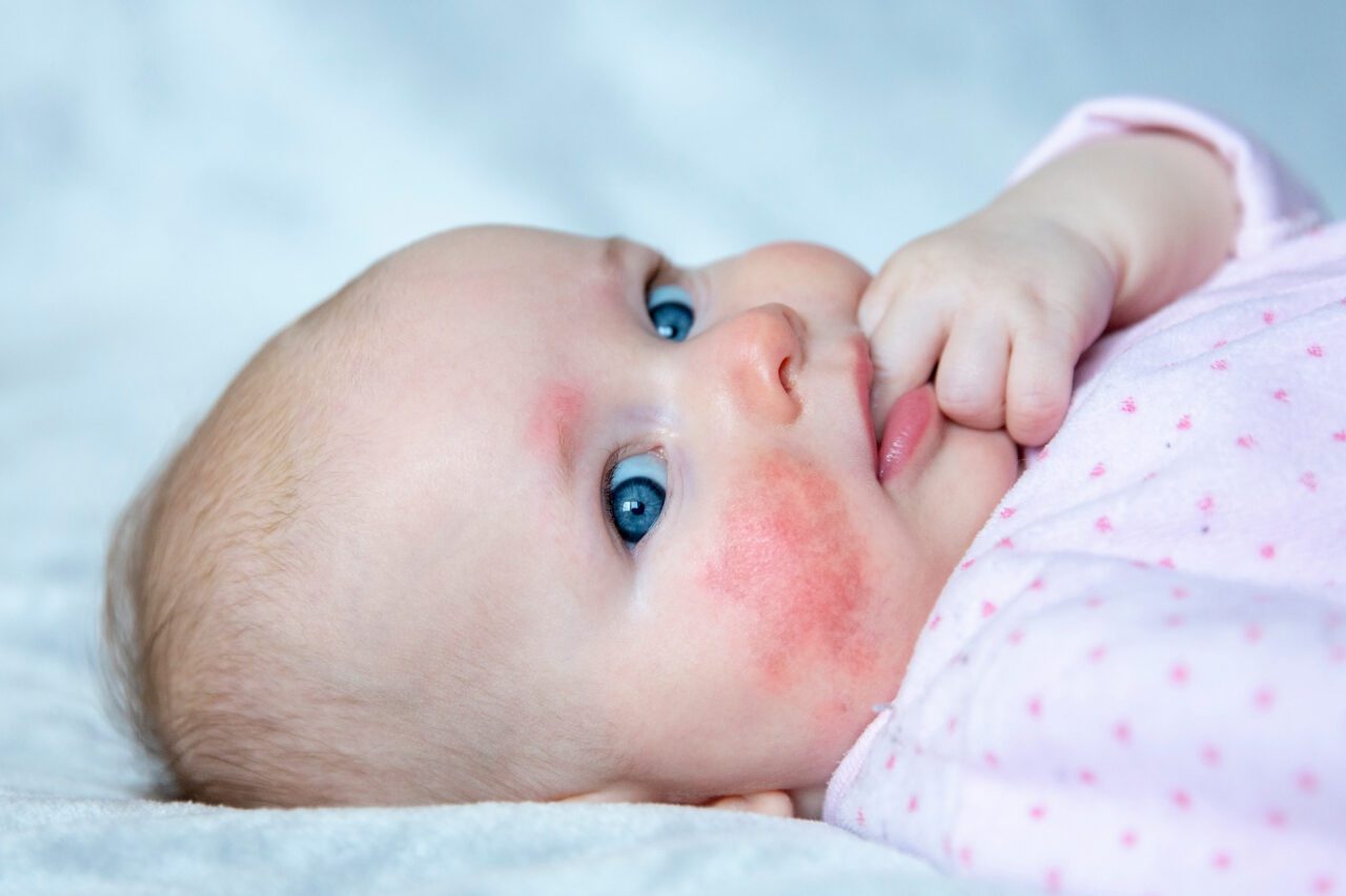 Baby with a rash on their cheek