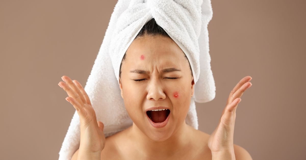 Natural Remedies for Skin Blemishes Gentle Care BLDG Active