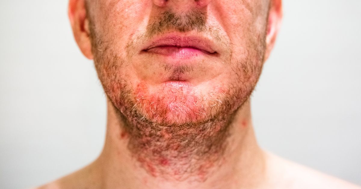 Managing Eczema and Stress Holistic Approach BLDG Active