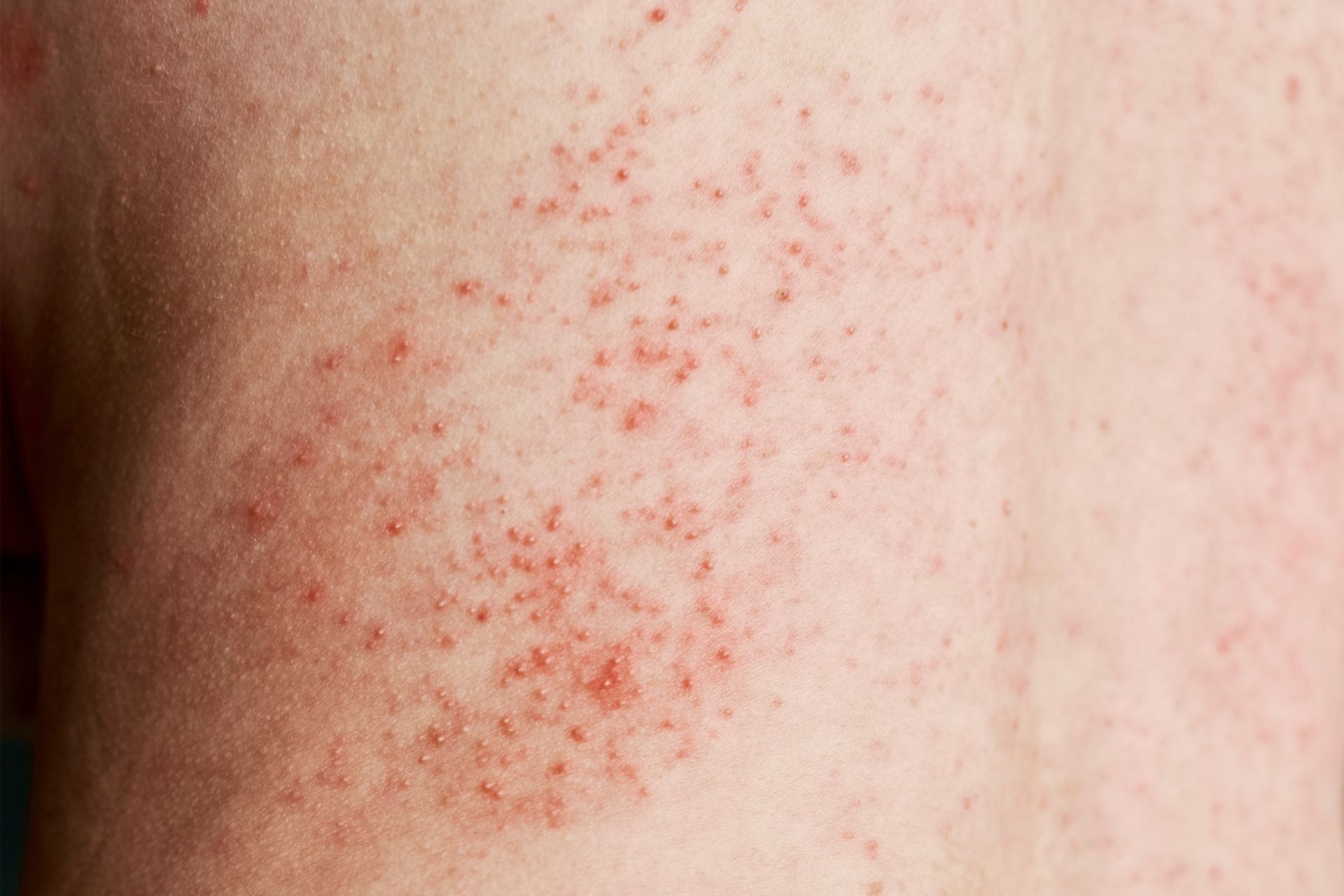 Identifying HaileyHailey Disease A Symptom Guide BLDG Active